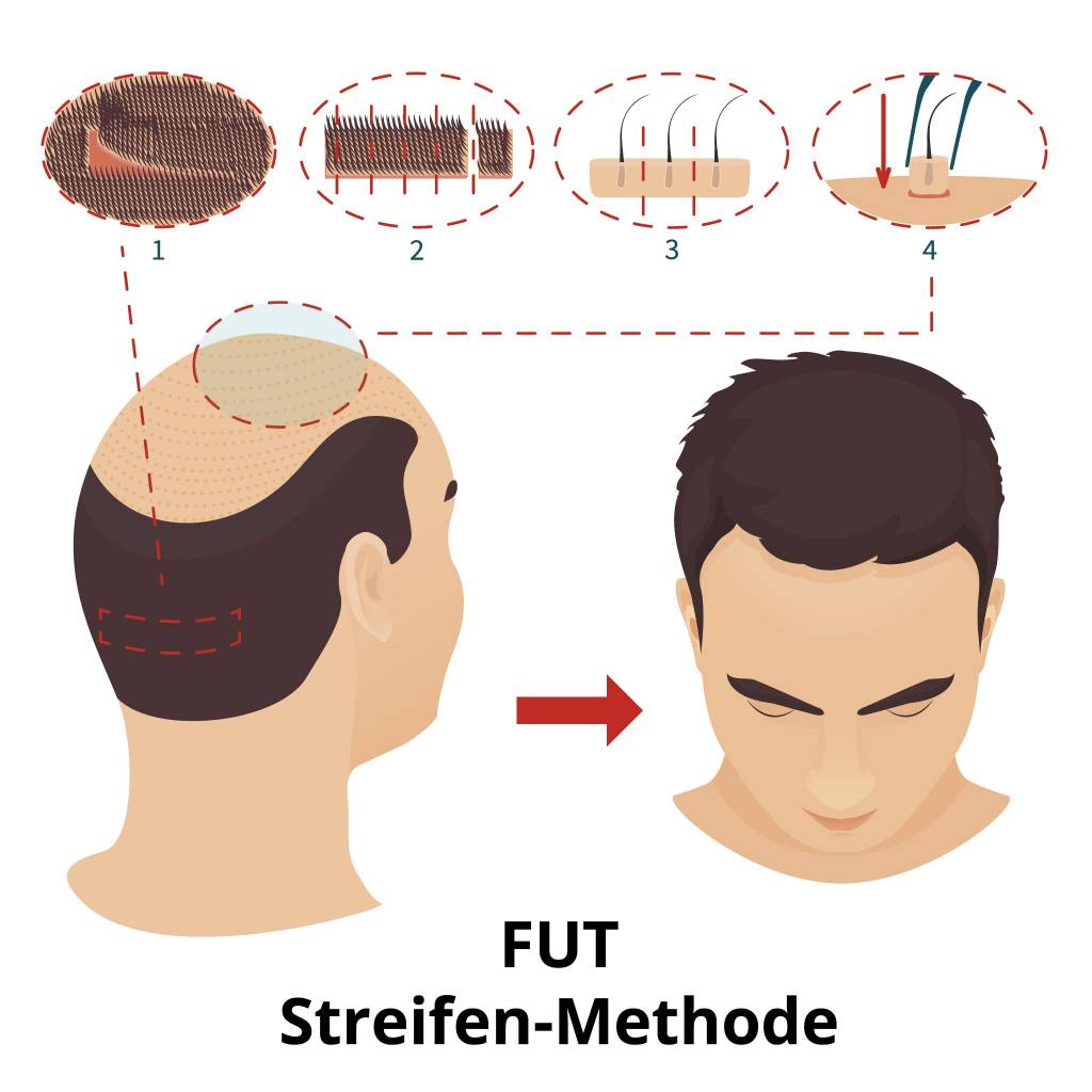 Haartransplantation Methoden Verlauf Erfolg Und Kosten